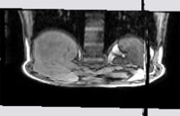 Przykładowy obraz 3d MRI wątroby: zdrowa