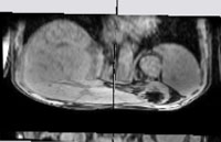 Przykładowy obraz 3d MRI wątroby: zwłókniona.