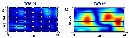 P. Strumiłło, J. Ruta, "Poincare mapping for detecting abnormal dynamics of cardiac repolarization"