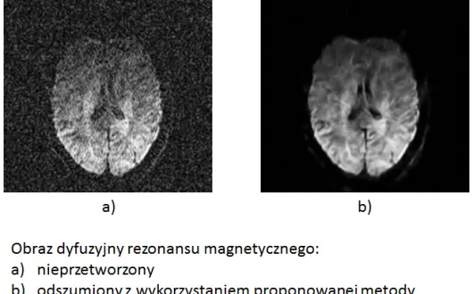 Obraz dyfuzyjny rezonansu magnetycznego