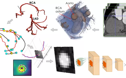 Estymacja parametrów geometrycznych naczyń krwionośnych. Etykiety ekspertów naniesione na obrazy angiograficzne zostały wykorzystane do stworzenia zbioru treningowego, umożliwiającego uczenie sieci neuronowej, mającej na celu estymację parametrów geometrycznych naczyń krwionośnych.