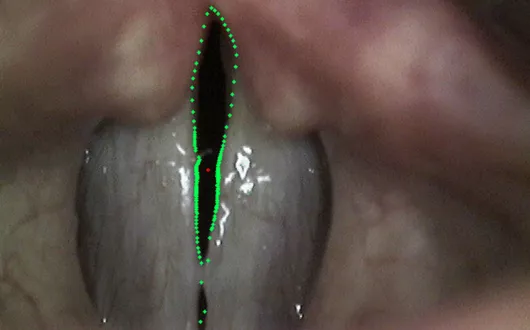 Analiza obrazów laryngoskopowych