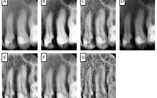 Przykładowe zdjęcia rentgenowskie przedtrzonowca przetworzone z użyciem ocenianych metod wzmacniania obrazu. Ulepszone obrazy pokazują różny stopień poprawy kontrastu oraz widoczności szczegółów anatomicznych. (A) Oryginał, (B) HE, (C) CLAHE, (D) KFCDO, (E) G-CLAHE, (F) CLAHE-POA, (G) TV-CLAHE.