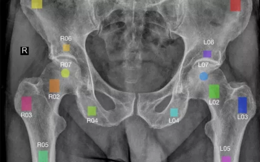 Obraz RTG stawu biodrowego z zazaczonymi analizowaymi obszarami zainteresowania