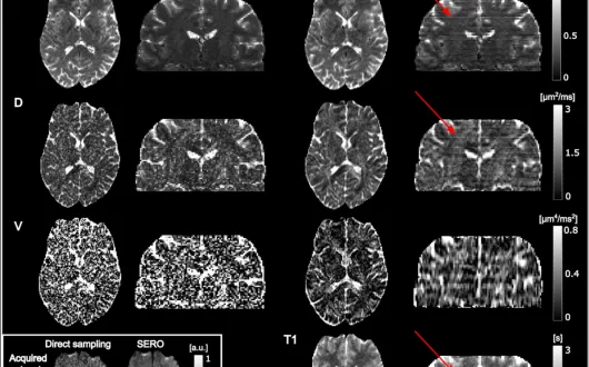 Parametry dyfuzji i relaksacji oszacowane w zdrowym mózgu na podstawie bezpośredniego próbkowania o wysokiej rozdzielczości oraz SERO z SRR. 