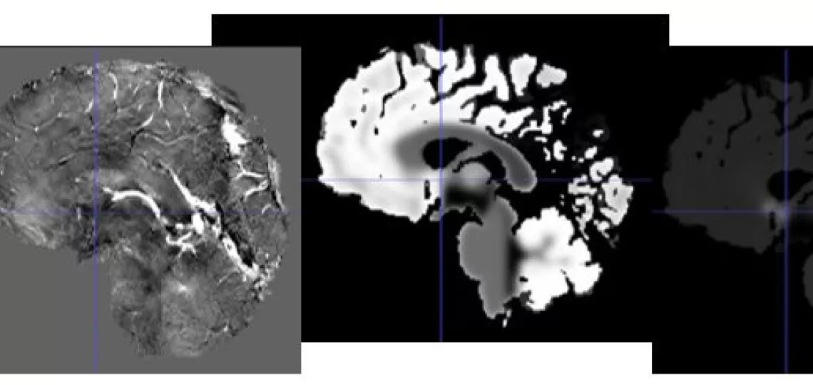 MR images of the brain, from left: TOF, SWI, fractional blood volume, mean vessel density, mean vessel radius.