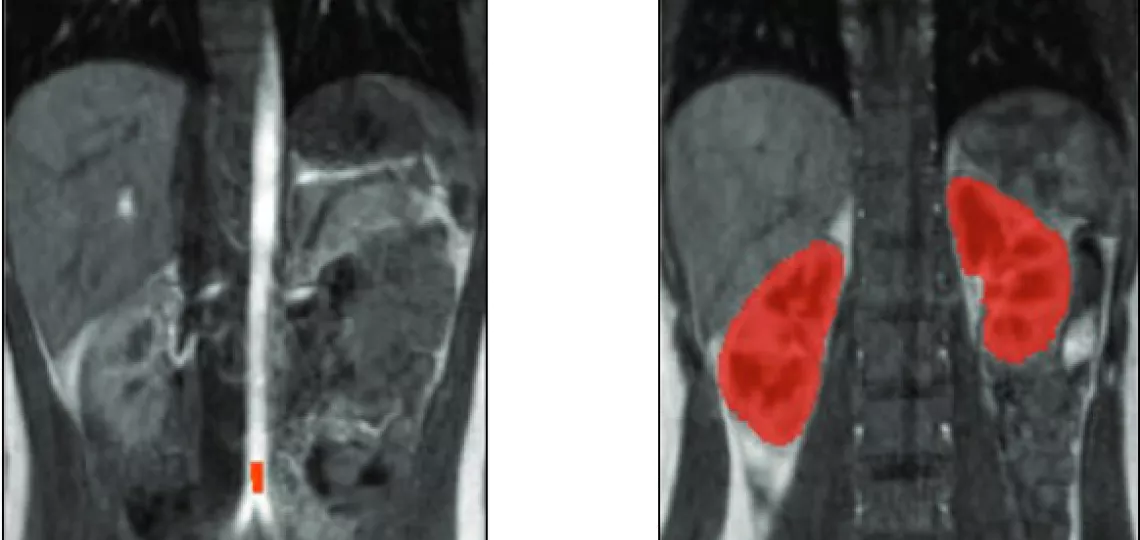 Przykładowe obrazy DCE-MRI oraz wynik wstępnej segmentacji nerek.
