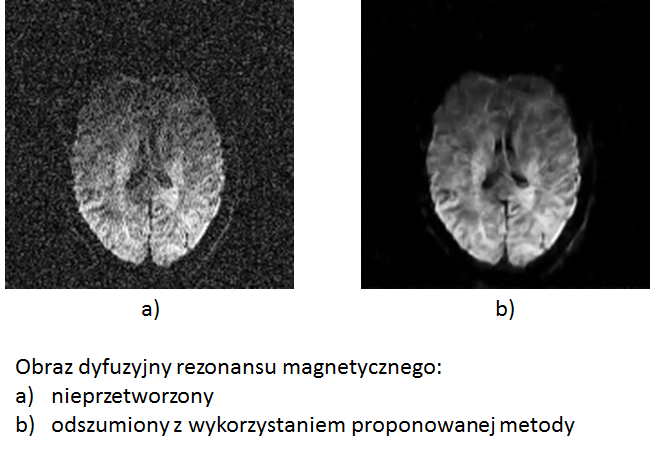 Obraz dyfuzyjny rezonansu magnetycznego