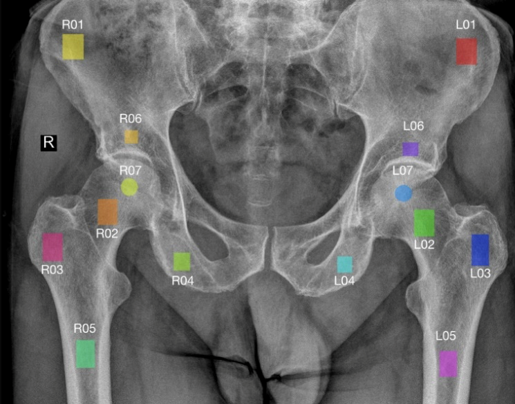 Obraz RTG stawu biodrowego z zazaczonymi analizowaymi obszarami zainteresowania